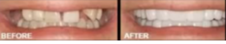 All On Four Dental Implants Long Island